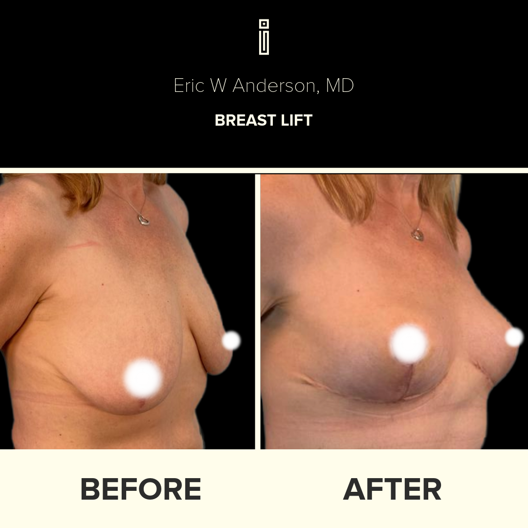 Dr.Anderson_B&A copy-83-Stephanie.S -  Breast Lift page