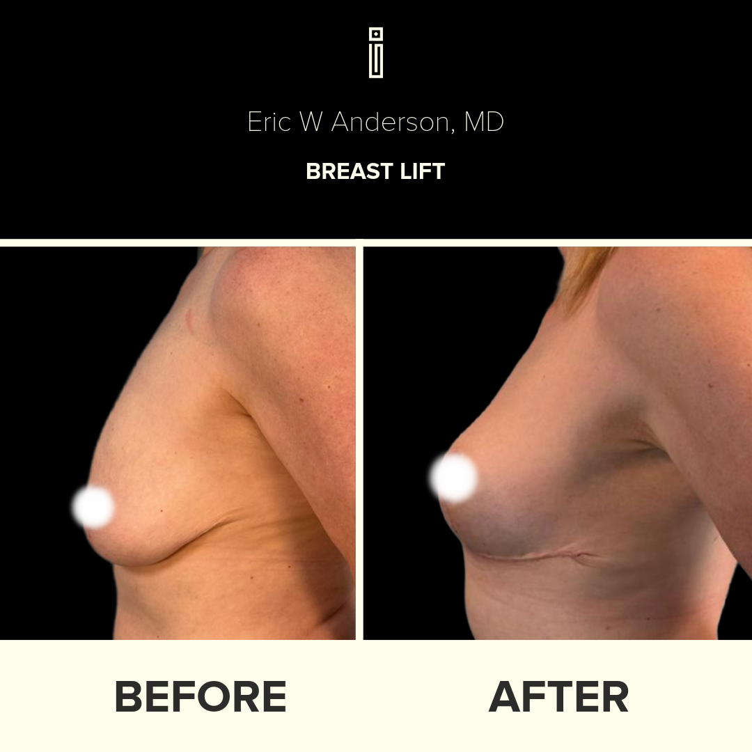 Dr.Anderson_B&A copy-84-Stephanie.S -  Breast Lift page