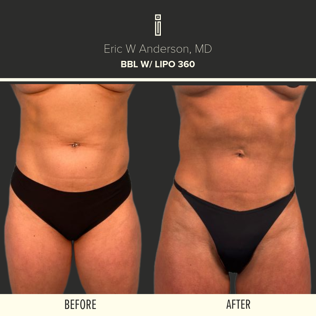 Fat Transfer