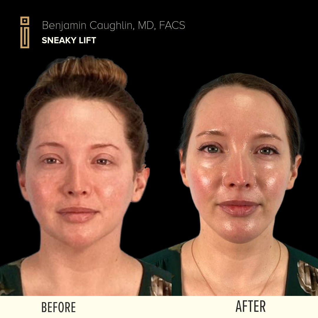 Before & After The Sneaky Lift lower face procedure in Chicago - Impressions Face + Body