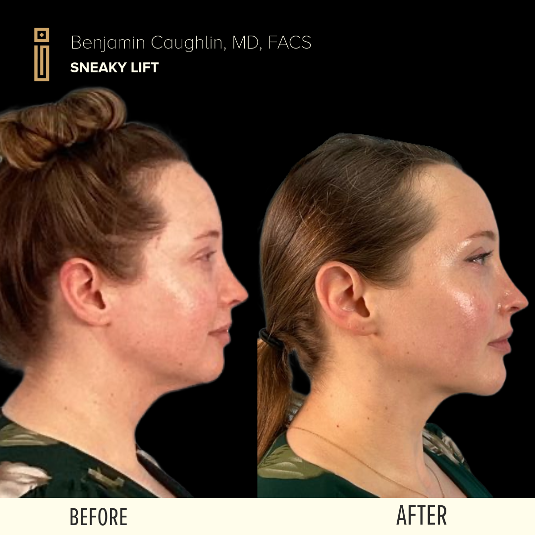 Before & After The Sneaky Lift lower face procedure in Chicago - Impressions Face + Body