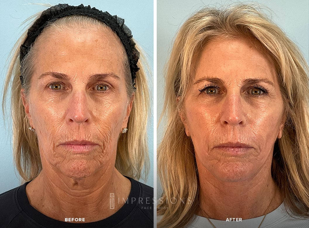 Before and after facelift surgery demonstrating a more youthful and refreshed appearance.