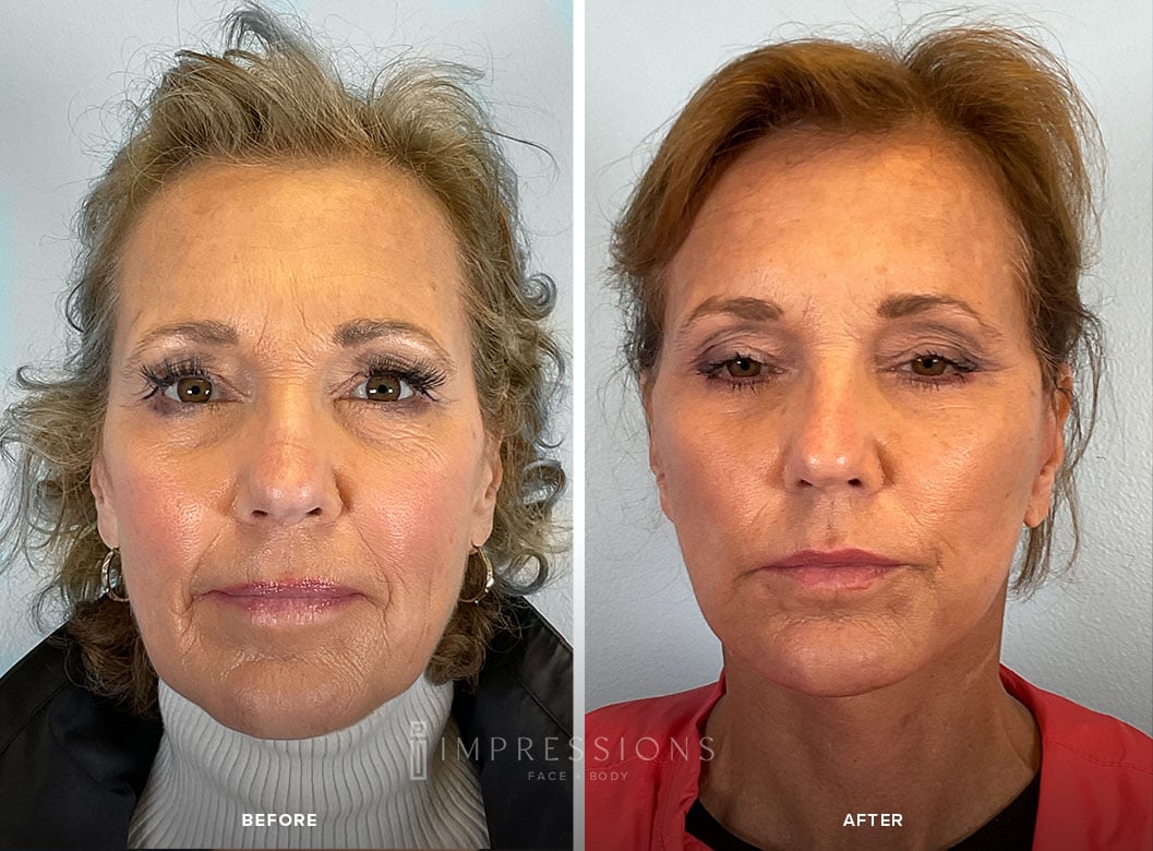 Facelift Before & After Images_4