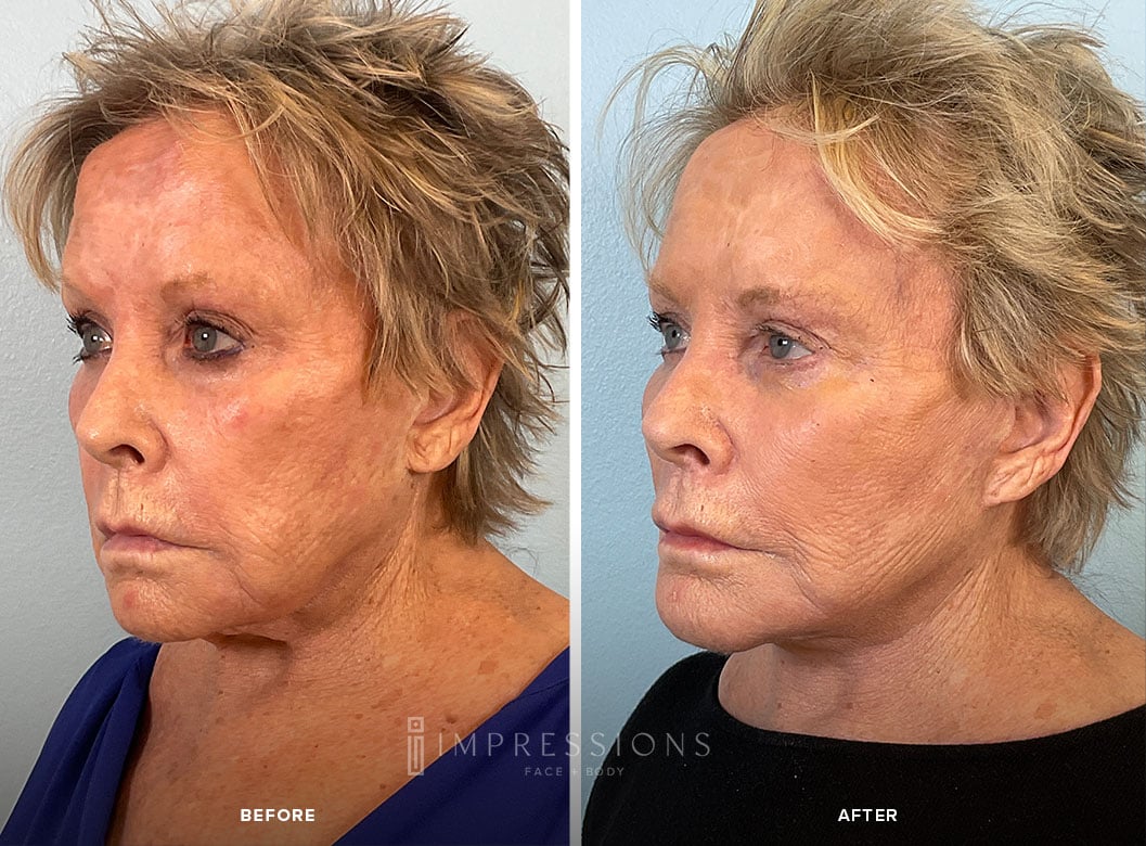 Facelift Before & After Images_5