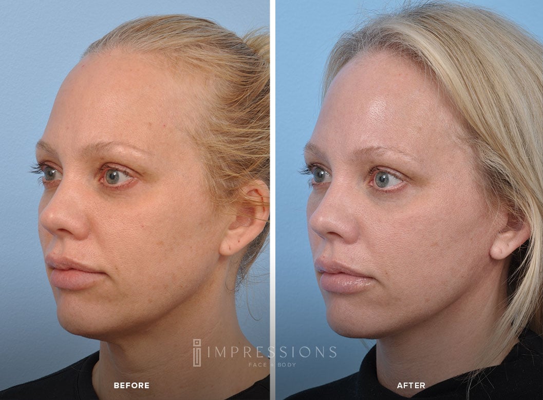 Facelift Before & After Images_2
