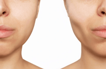 Facial Slimming