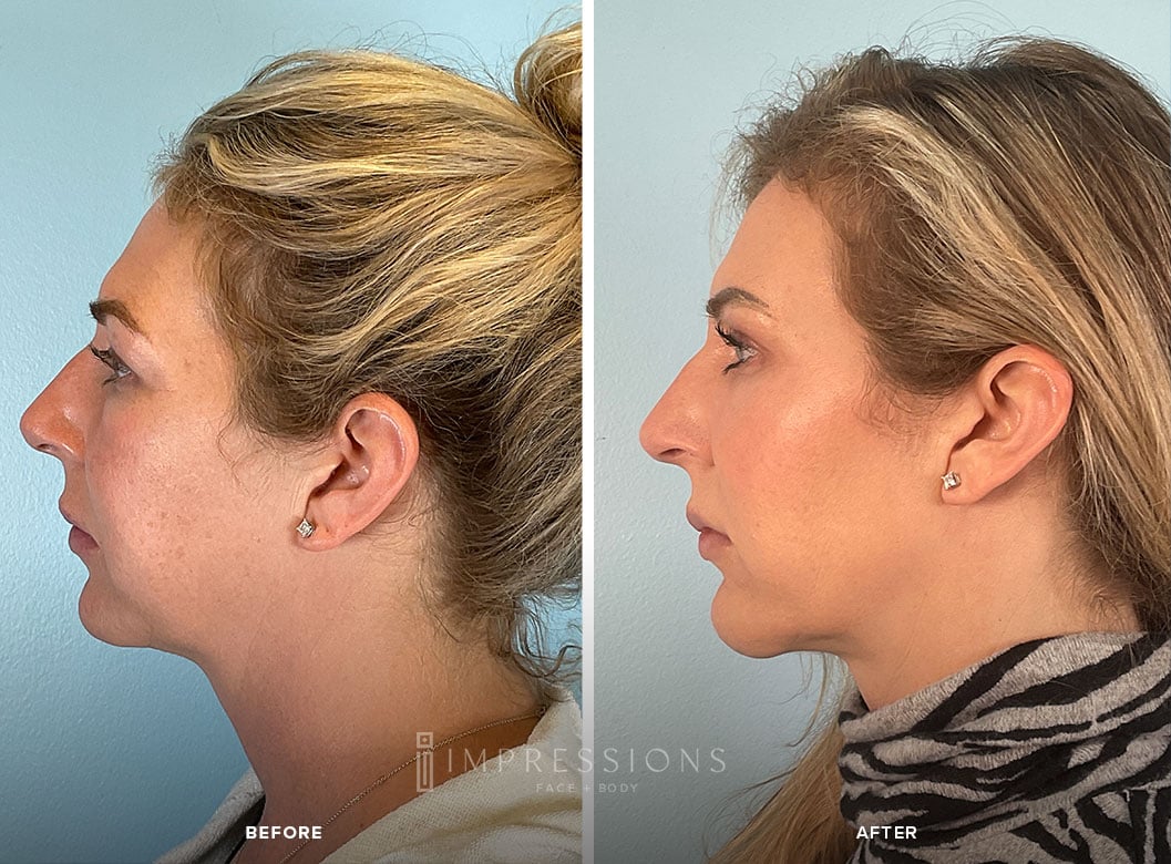 Jawline_Case_1_Shot#3