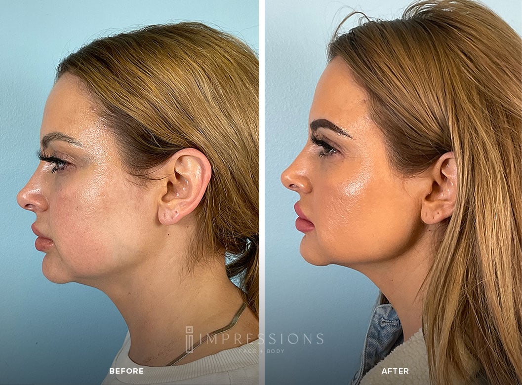 Jawline_Filler_Case_1_Shot1-1