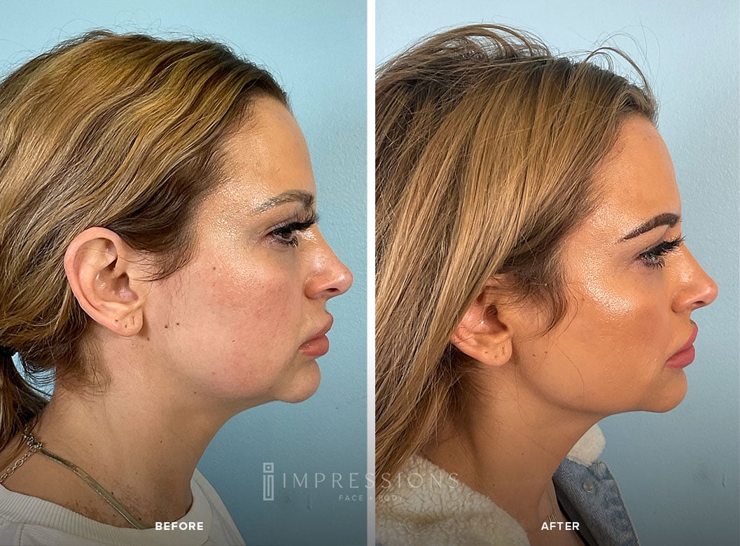 Jawline_Filler_Case_1_Shot2