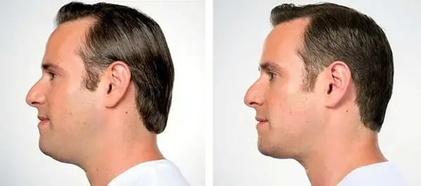Kybella-in-Chicago-for-Double-Chin
