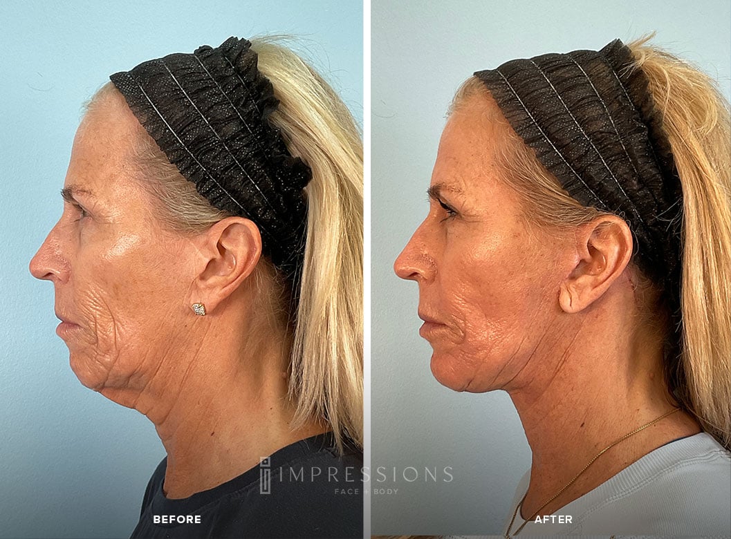 Necklift_Case_1_shot#2-1