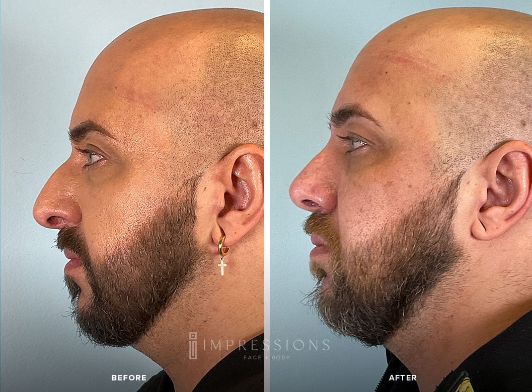 Rhinoplasty Before & After Images_1