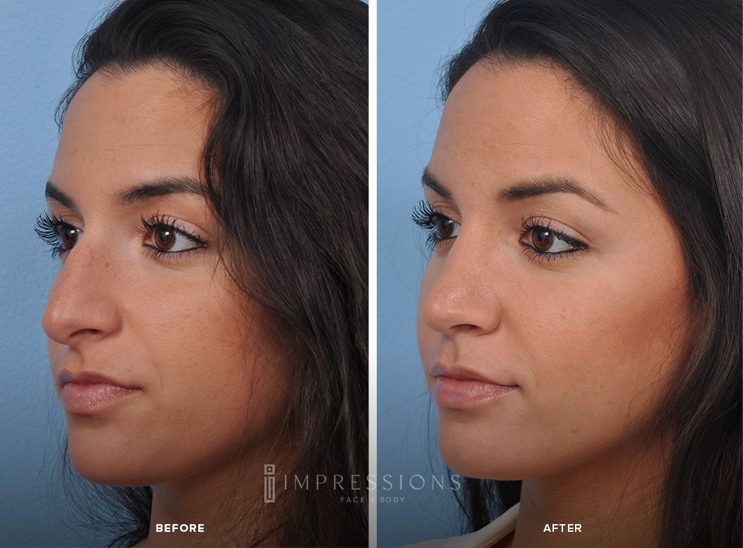 Rhinoplasty Before & After Images_2
