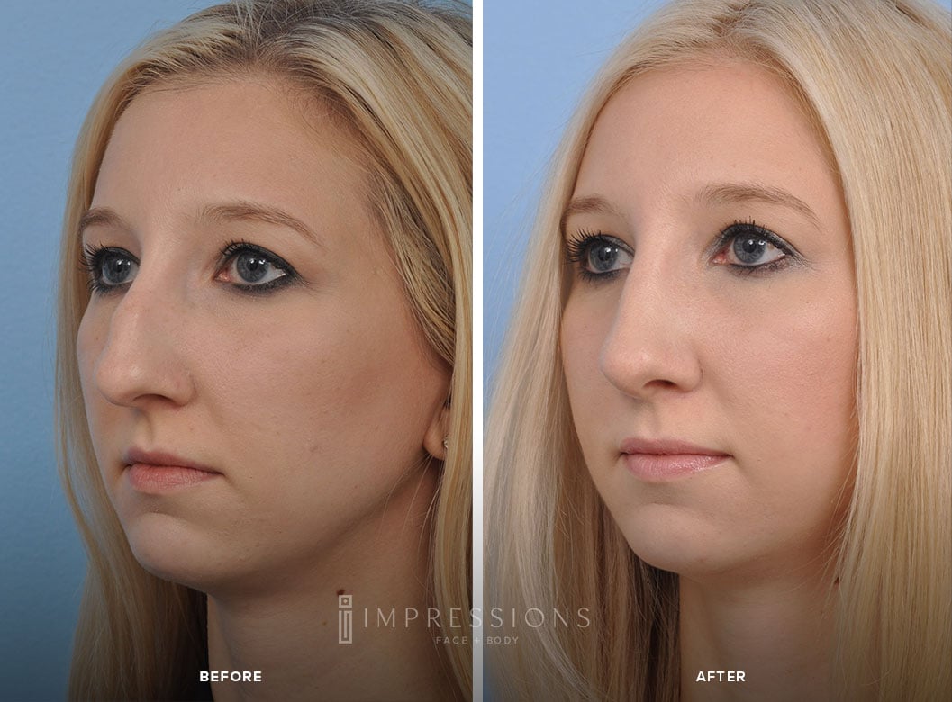 Rhinoplasty Before & After Images_3