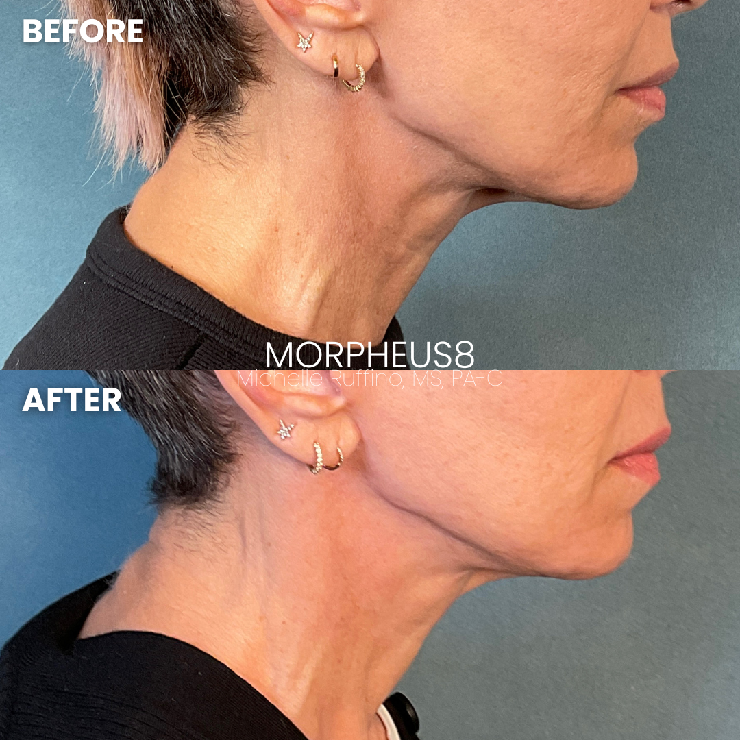 SDMD- BeforeAfter - 2023-04-27T124206.630-1