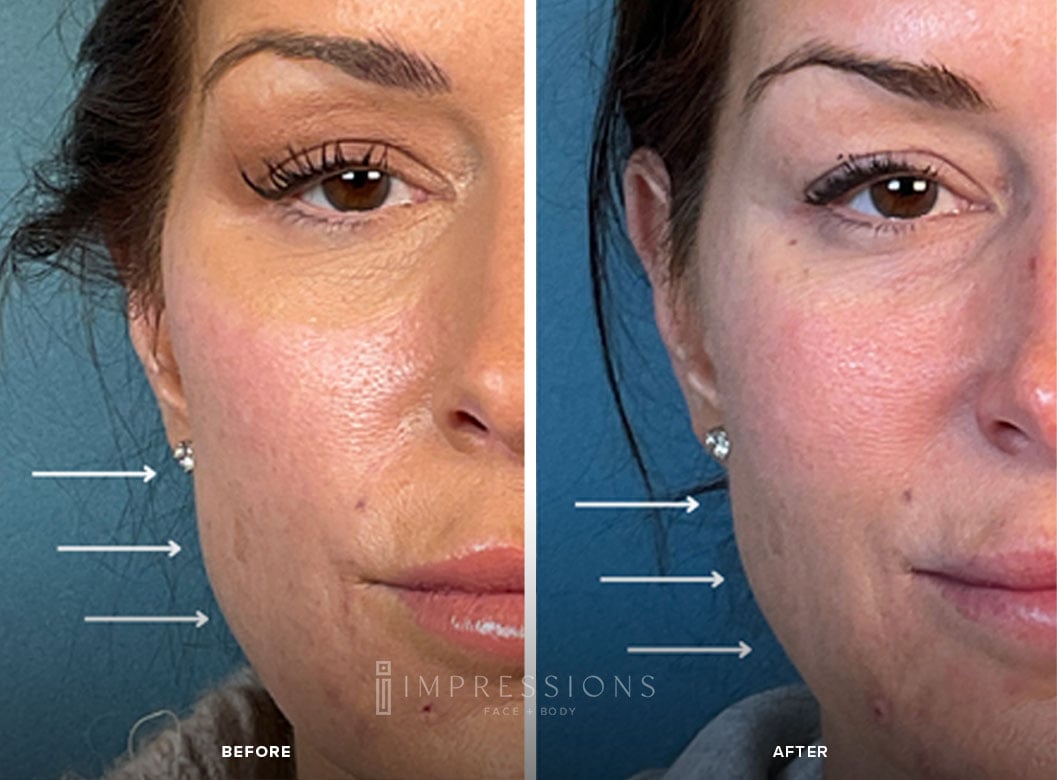 Sculptra_Case_1_Shot_1