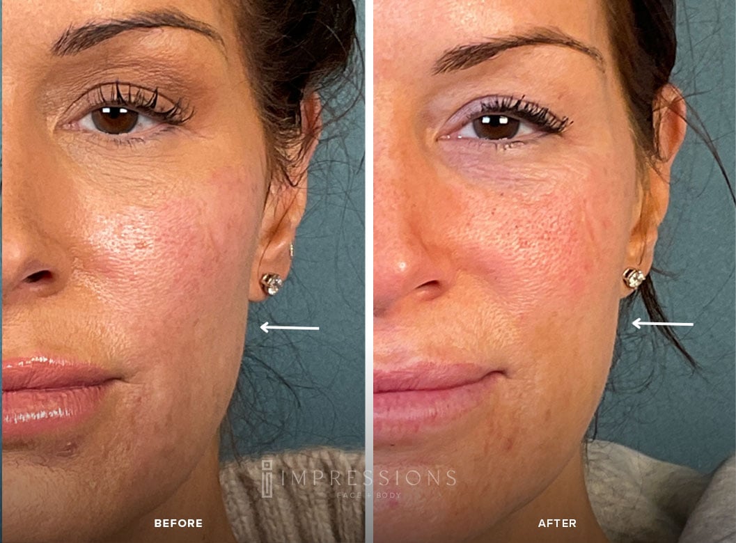 Sculptra_Case_1_Shot_2