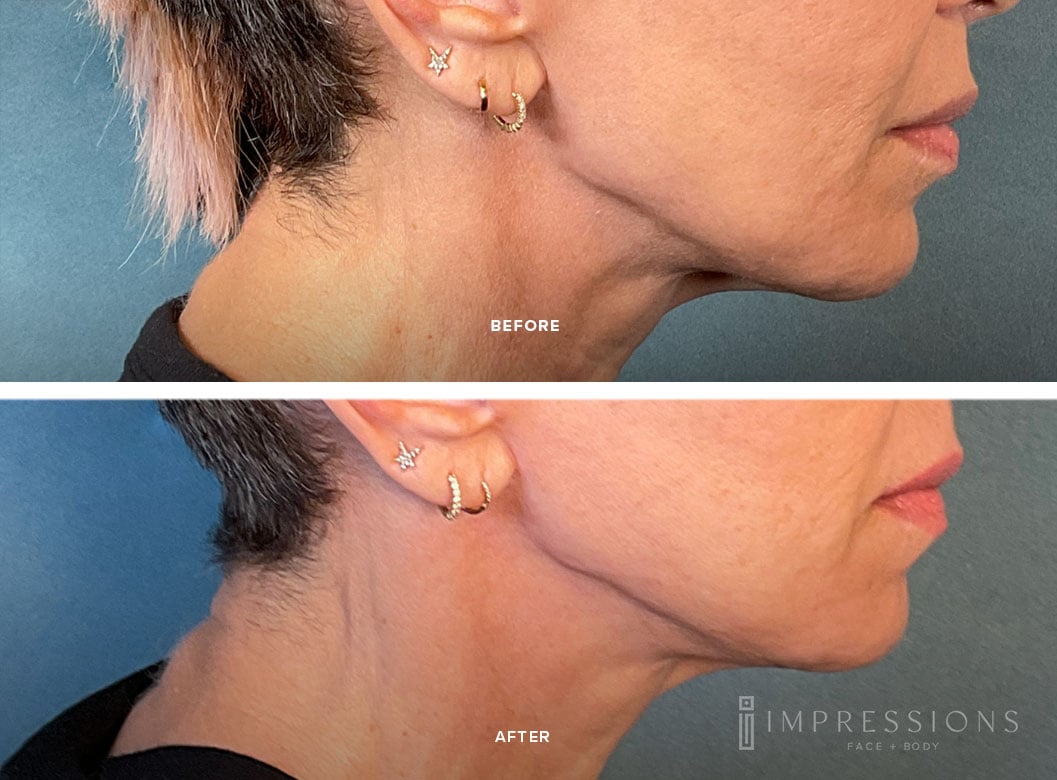 Skin_Tightening_Case_1_Shot_1