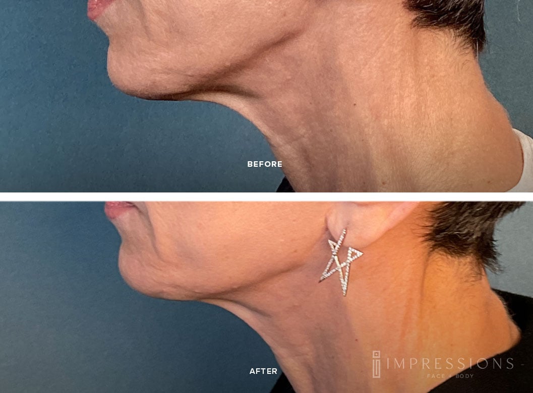 Skin_Tightening_Case_1_Shot_2