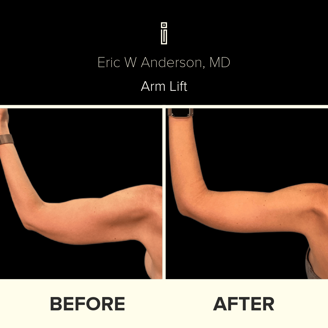 armlift (1)-1