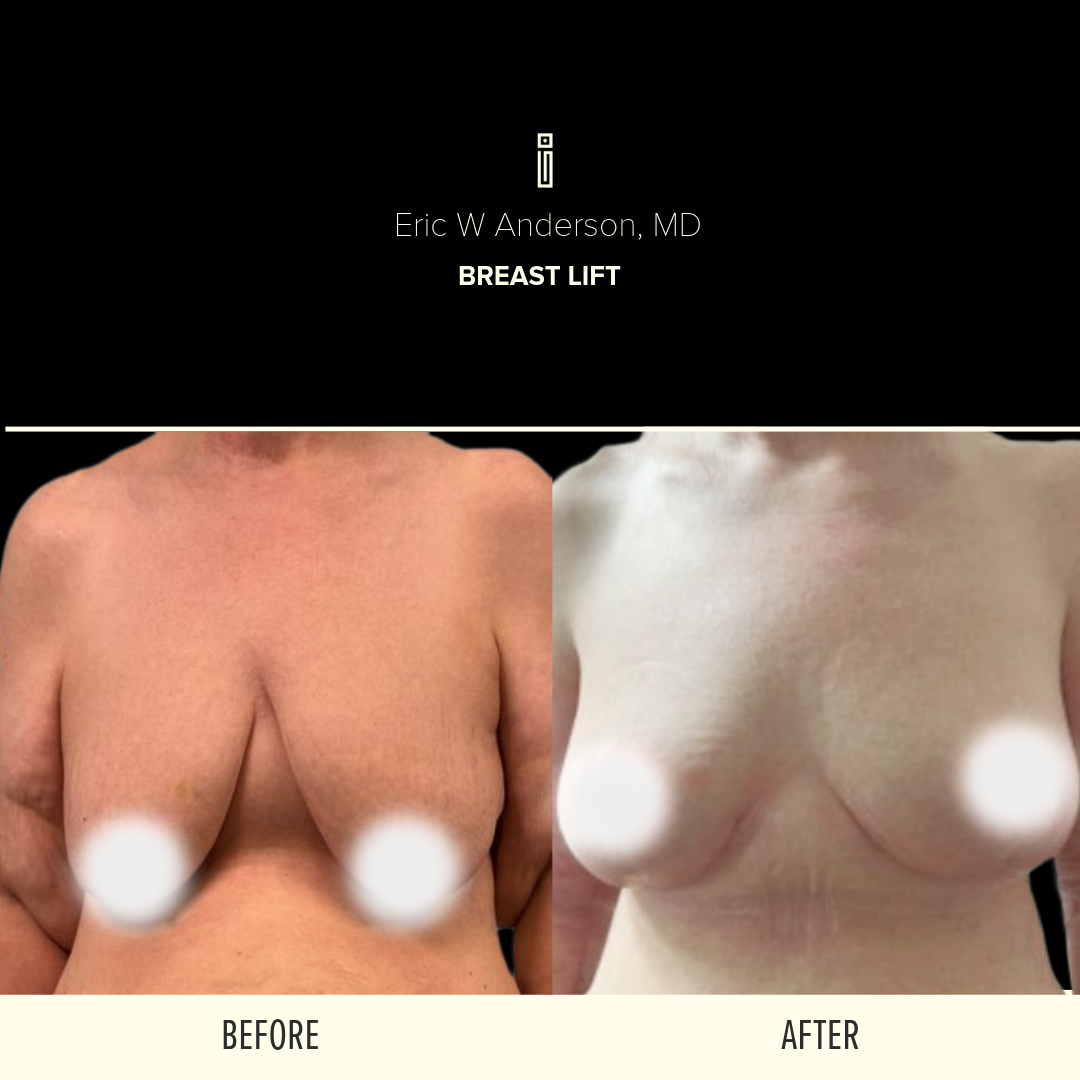 A before and after photo of a breast lift by Dr. Anderson at Impressions Face + Body Chicago.