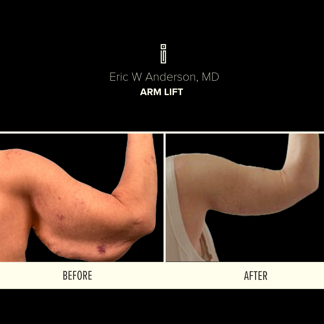 Before and after of arm lift procedure by Dr. Anderson at Impressions Face + Body Chicago