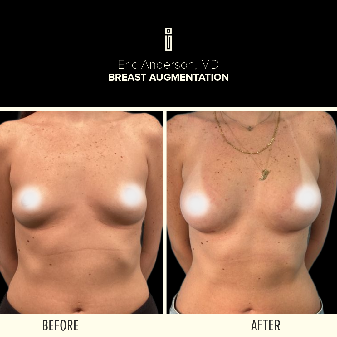 Body Before and After