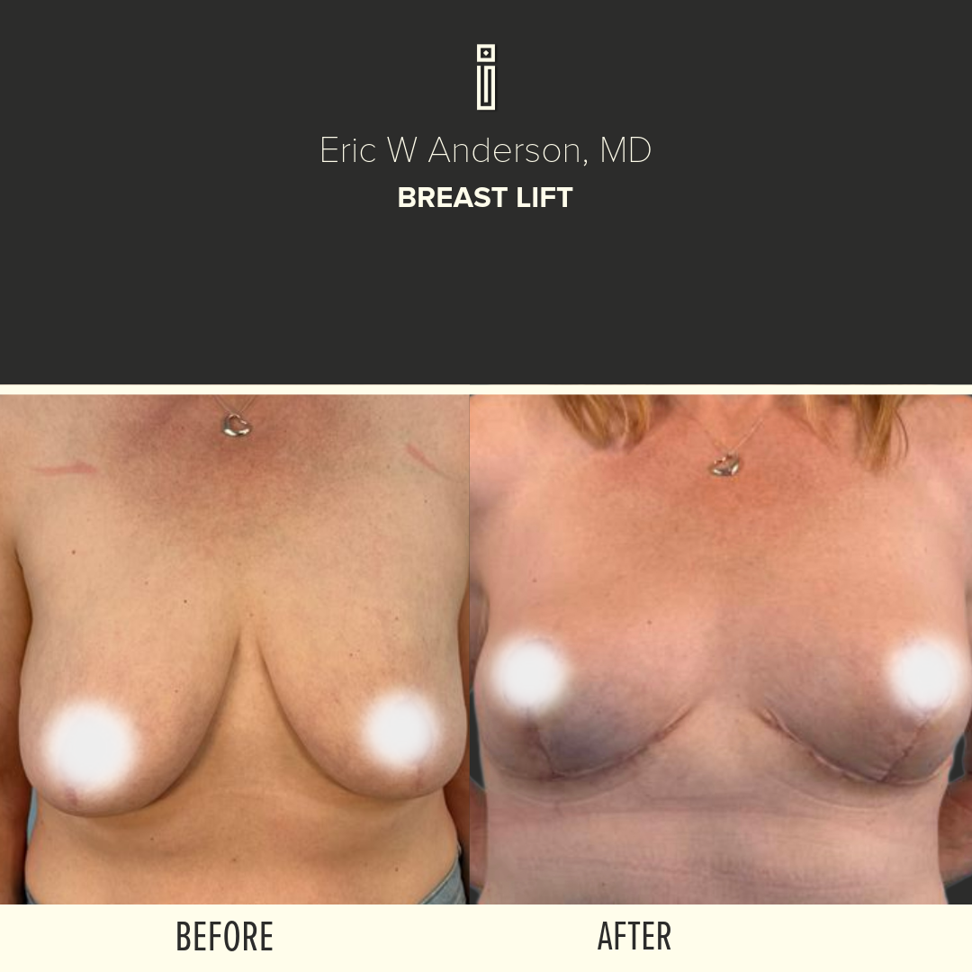 Body Before and After