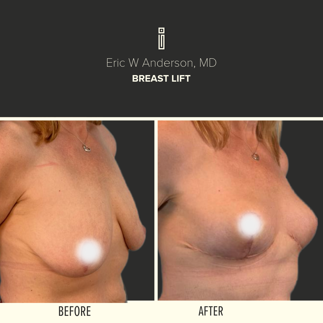 Body Before and After