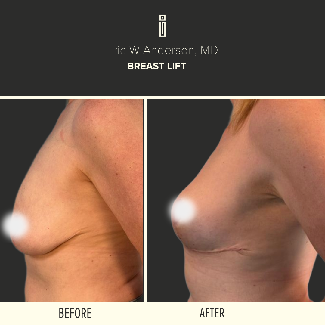 Body Before and After