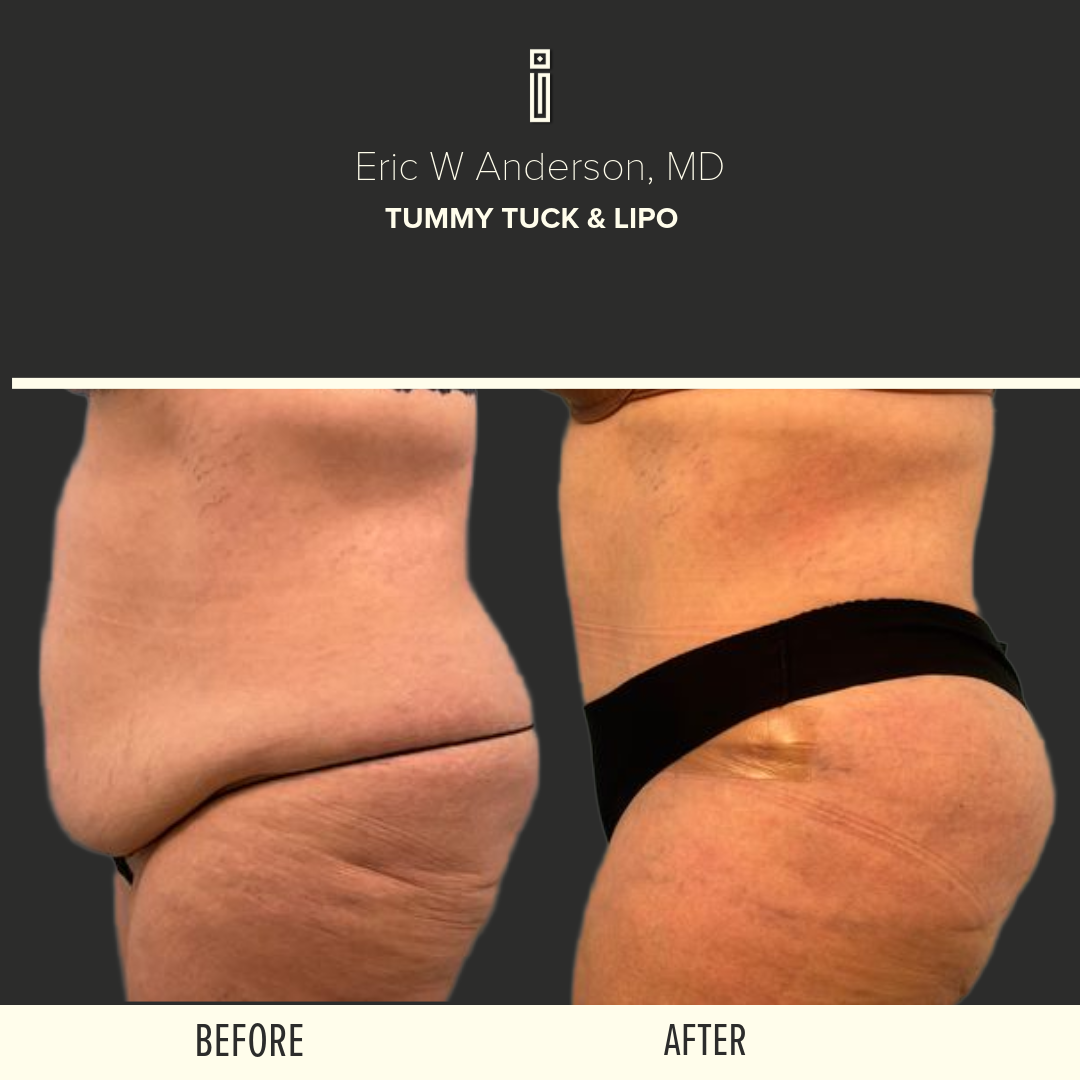 Body Before and After