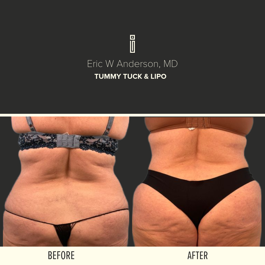 Body Before and After