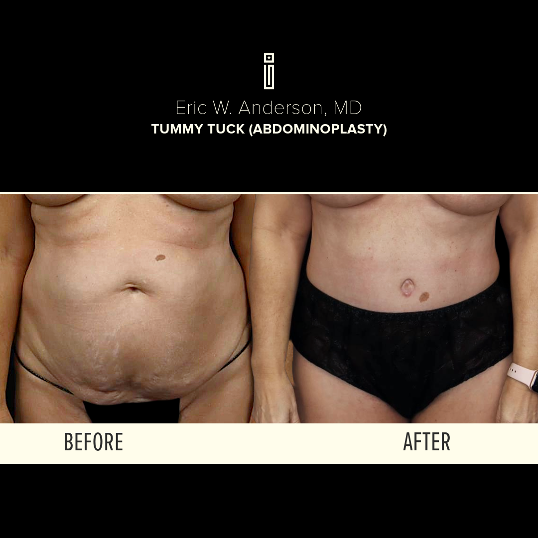 Before and after of tummy tuck procedure by Dr. Anderson at Impressions Face + Body Chicago